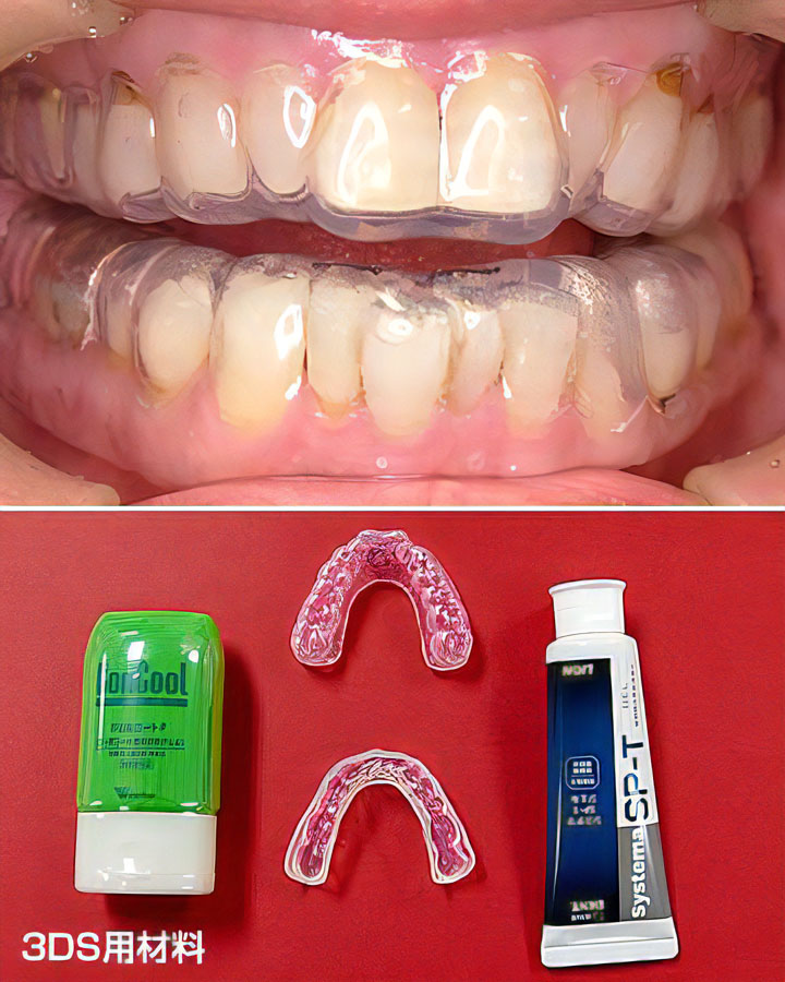 虫歯・歯周病予防法（3DS治療）