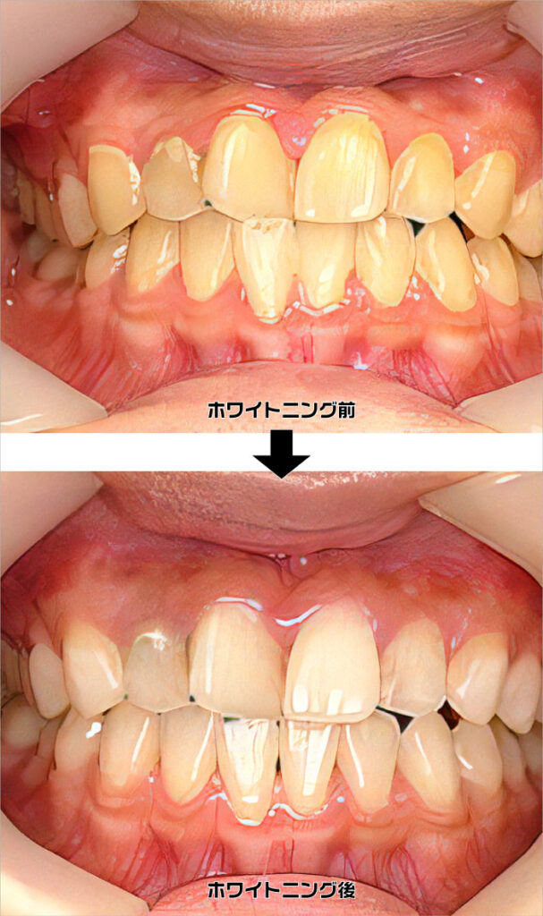 審美歯科（ホワイトニング）施術法
